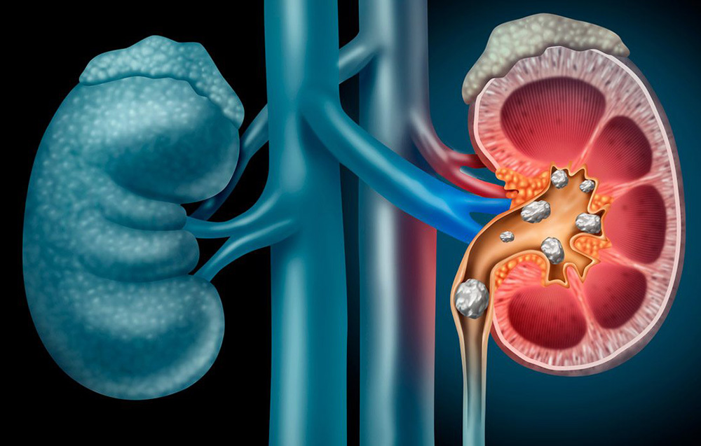 Litiasis En Vía Urinaria